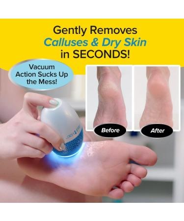 Electric Callus Remover + Built-In Vacuum Sucks Up Shavings, New Look, Gently Removes Calluses