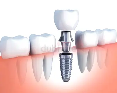 Dental Implant@Dhs1500 with crown